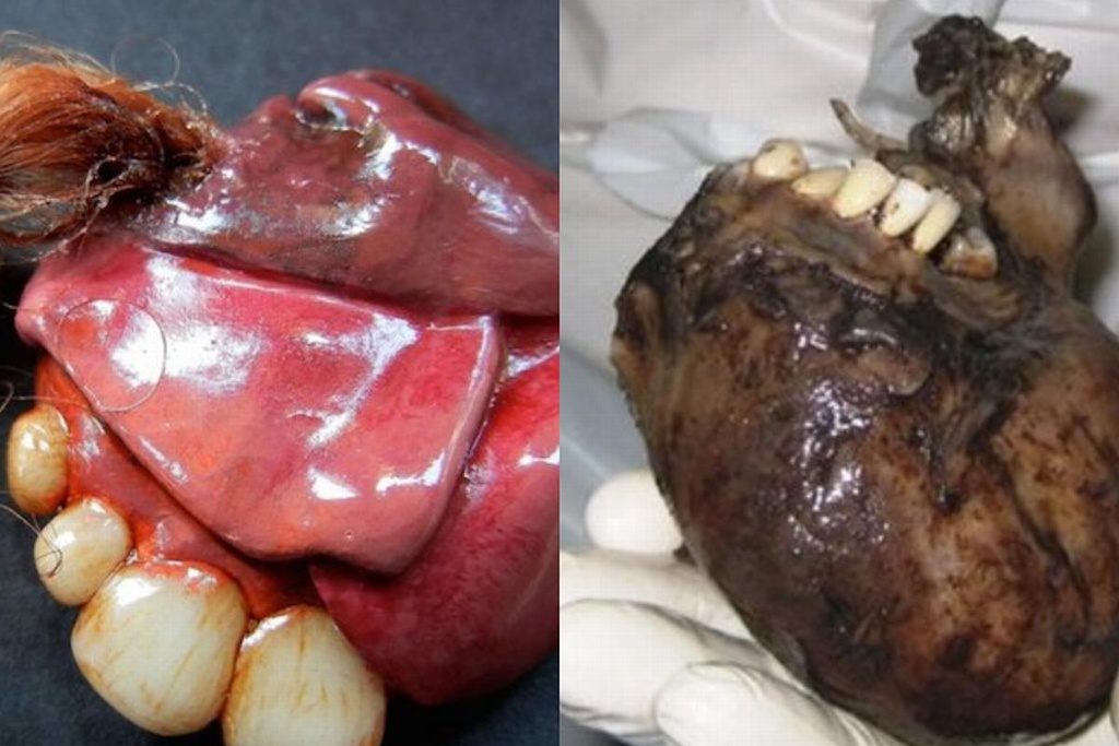 Teratoma: el tumor con dientes, cabello y otras partes humanas